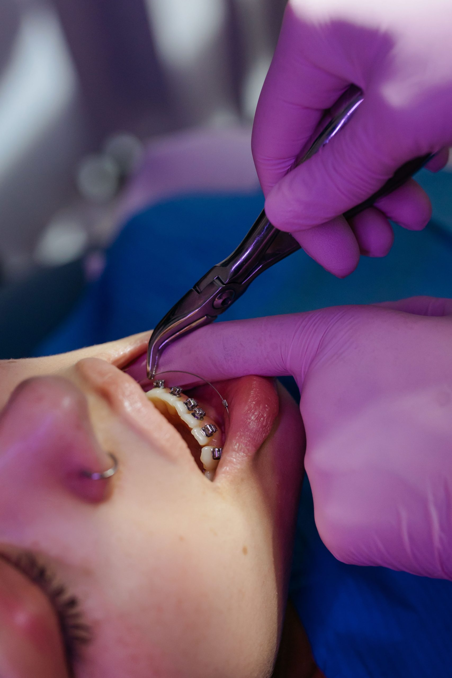 Advanced Metal Braces